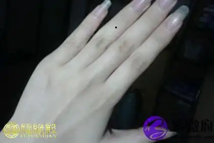 无名指有痣有何含义