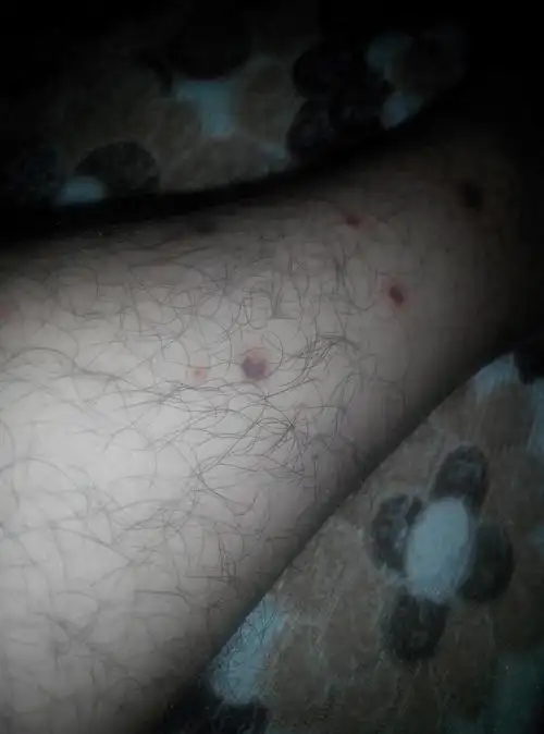 医生!我的小腿上起了一些疙瘩,好了又起还出现了伤口出浓