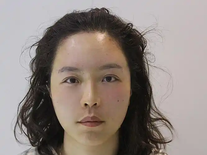 自体脂肪面部填充术后即刻