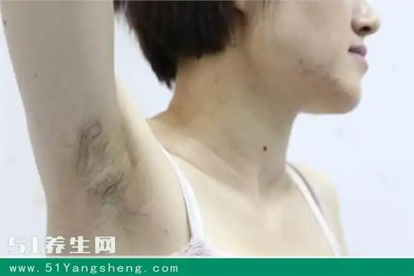 腋毛癣是什么?