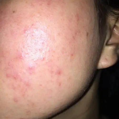 到现在也一年了,反反复复,脸一直这样,吃辣椒也会过敏,最近没有吃辣