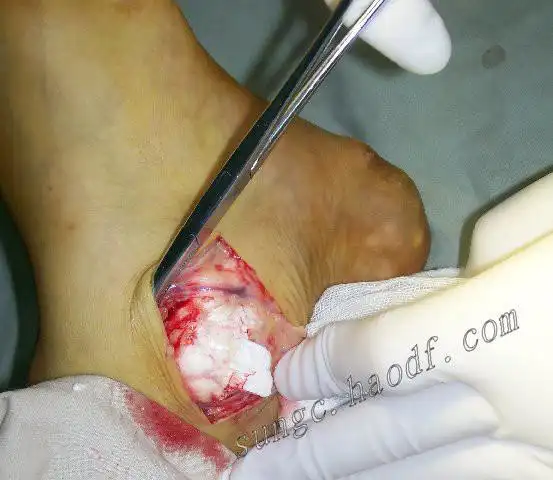 远离痛风可怕的痛风石附手术图片