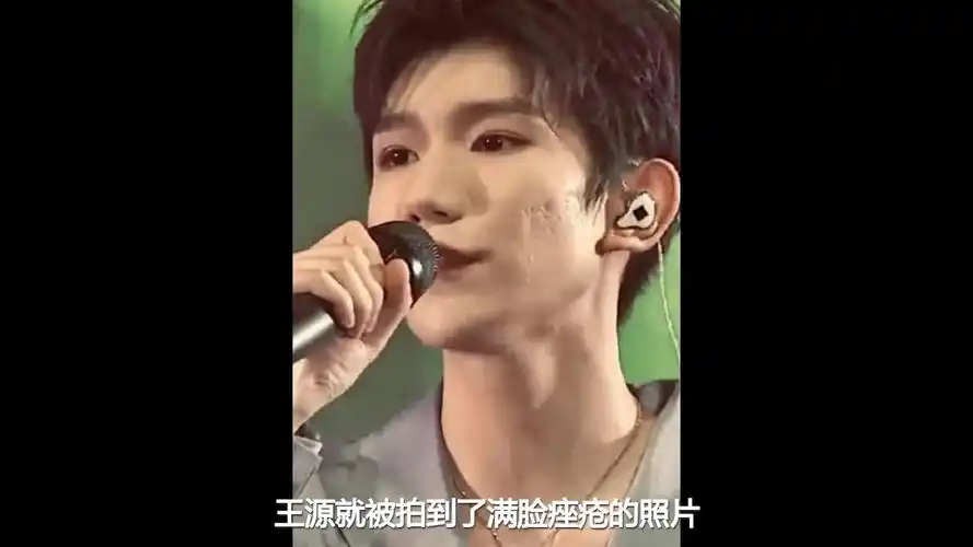 王源脸部痤疮严重近镜头下一言难尽你才19岁啊