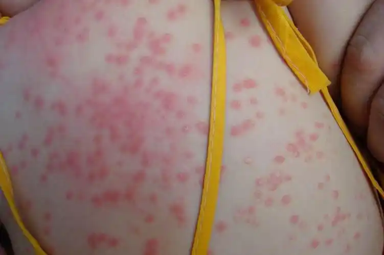 腿部夏季皮炎症状图片