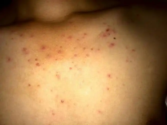 毛囊炎是毛囊浅部的感染性疾病,需要进行抗感染处理.