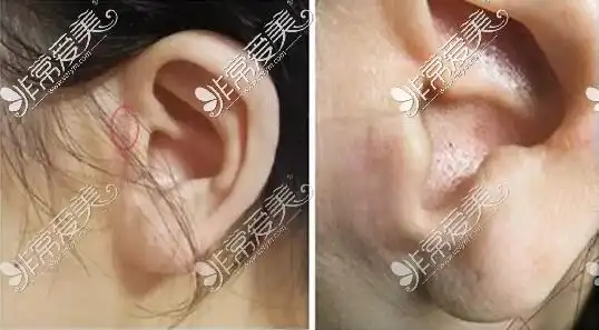 相关阅读:在深圳南雅整形做小切口拉皮,何奇医生技术分享!