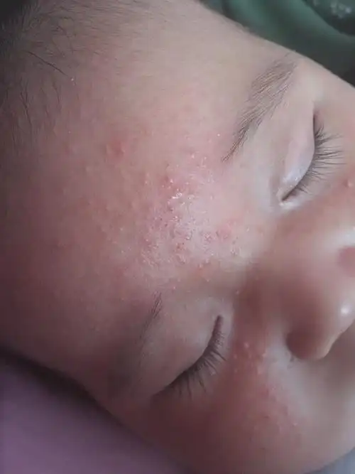 宝宝湿疹