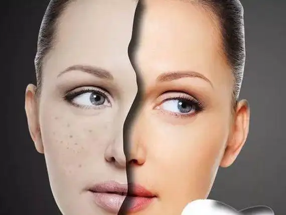 美白祛斑正当时,春季医美护肤美白学起来!