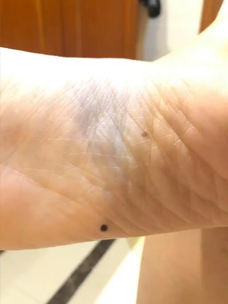 脚底板突然长痣 这颗痣应该是最近两三年长出来,感觉越来越黑,越来越