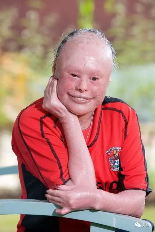 女子患鱼鳞病像蛇一样脱皮,一年掉80斤皮!