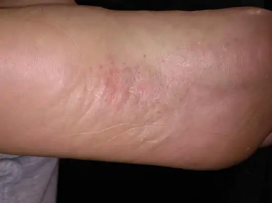 脚心起红疹的原因及应对方法