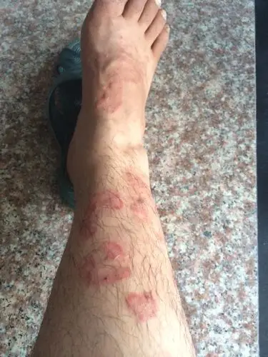 小腿和脚板上有明显红斑.听说是藓.圆状有点突起.