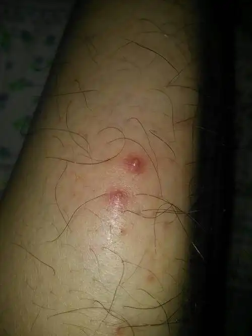 小腿上长了像是痘痘的东西,有点痒,穿上比较紧的保暖裤后跟裤子摩擦有