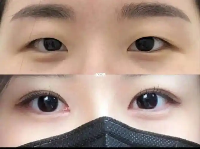 双眼皮对比单眼皮