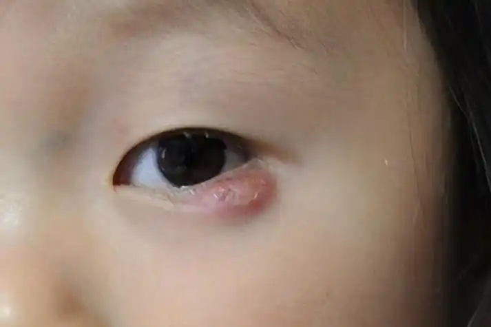 眼睛下方突然冒出红疙瘩图片_有来医生