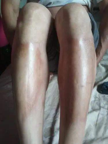 两条小腿面皮肤变色