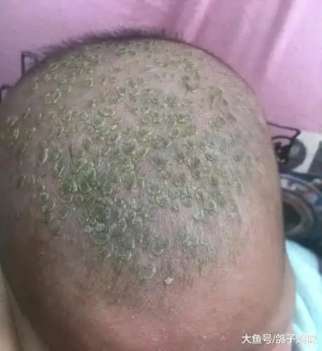 婴儿长绿头皮屑吓坏妈!医生提醒别乱抠