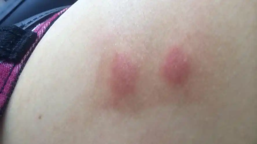 身上起红疙瘩很痒怎么办