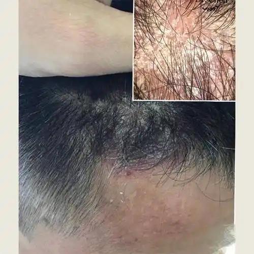 男女通用的去屑洗发水_问题_头皮屑_头发