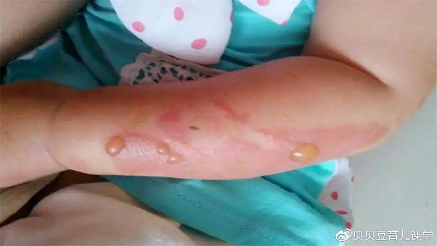 技术好!小孩烫伤怎么办"怀孕前期"-第2张图片-明城博客
