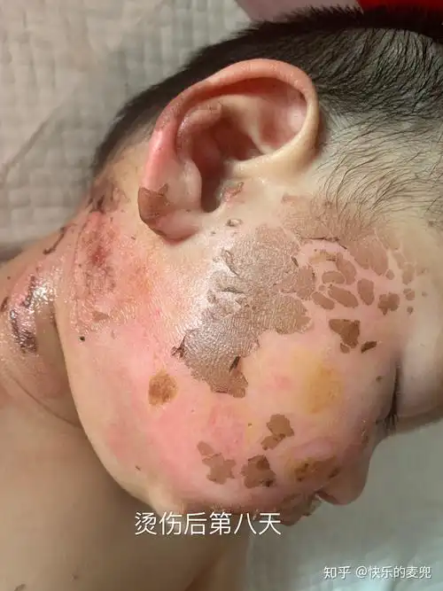 记录我一岁的宝宝被开水烫伤脸蛋
