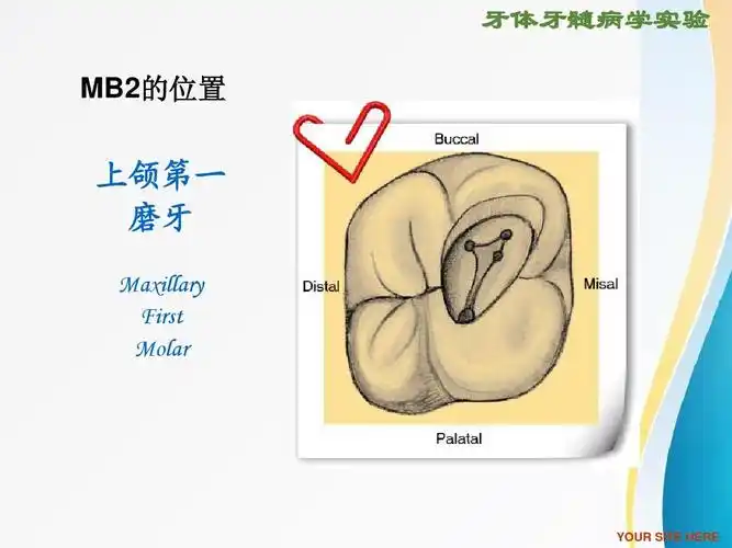 临床医学 rct根管治疗ppt 牙体牙髓病学实验 mb2的位置 上颌第一 磨牙