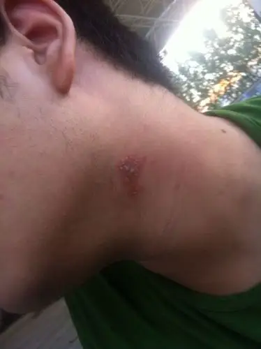 脖子上长的不知道是什么碰到有点痛摸着不舒服 害怕是艾滋病