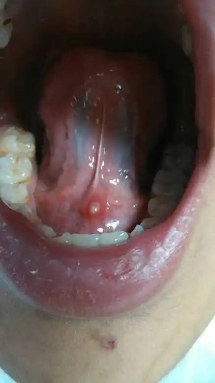 舌头溃疡怎么办 五岁孩子舌头溃疡怎么办