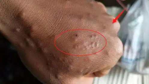肺癌早期不疼不痒,一旦手上出现这情况,肺部必然有癌细胞!