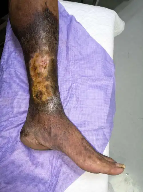 下肢皮肤坏死感染～慢创