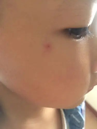 宝宝脸上有一个小血管,有半年了,我该怎么办