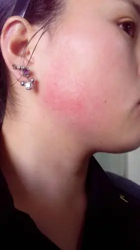 脸颊,怎么去掉,从小就有……………冬天更明显