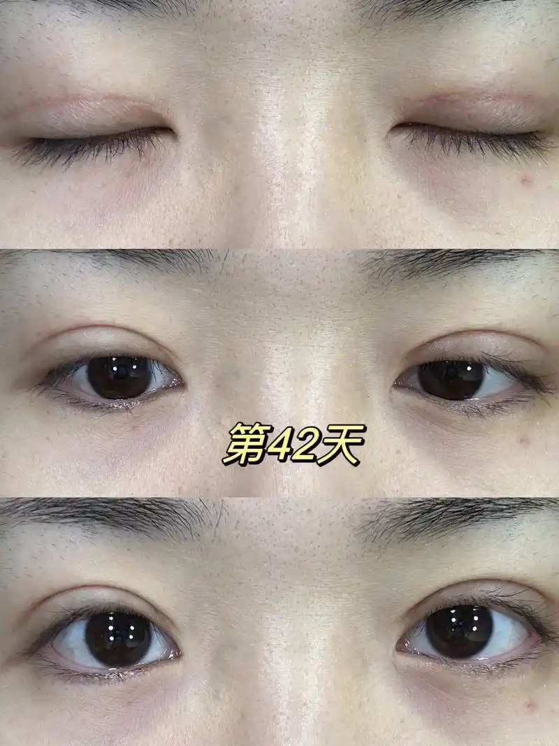 双眼皮恢复记录更新下对比照,这几天生病,没吃辣椒,伤口都不红 - 抖音