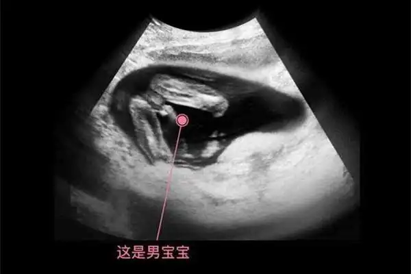 12周nt明显三条线生男孩这都是宝妈的真实经历