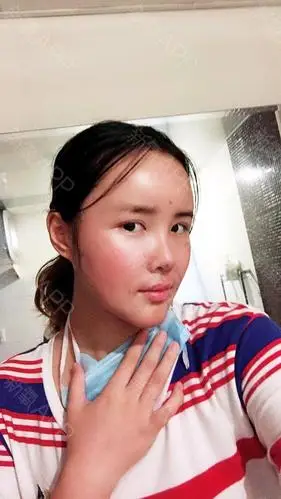 我做脂肪填充第三天了,脸感觉消肿了一些,但是已经可_圈子-新氧美容