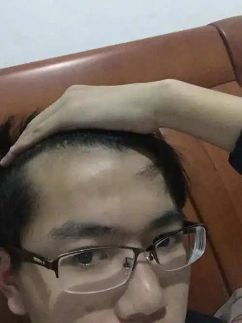 我的头发脱发好像很严重,额头旁边都没有了,我现在还是高三的学生