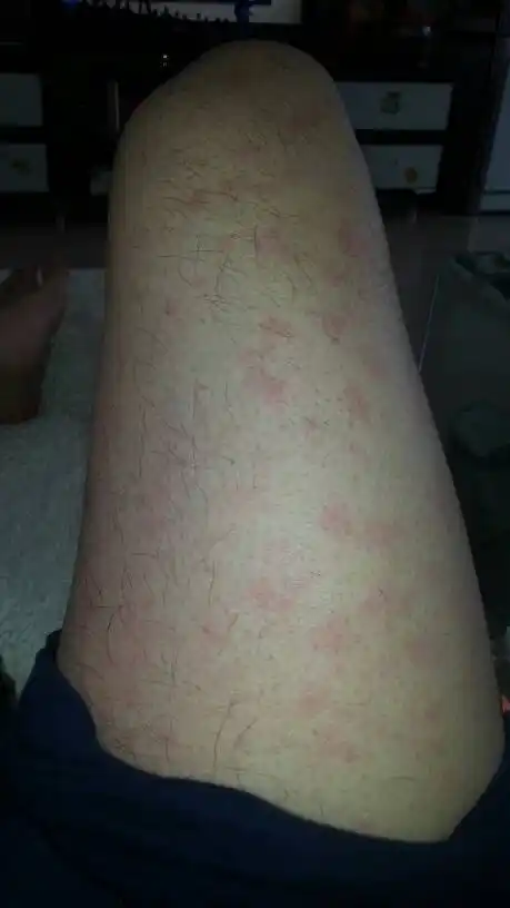 身上起了这些东西,有点痒,请问是什么症状?