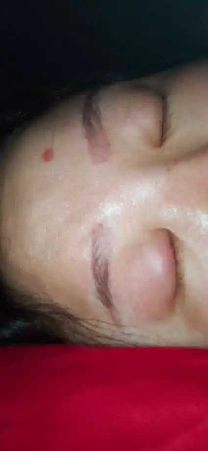 睡了一觉起来眼皮上长了一个红疙瘩,前几天不怎么痛,这几天开始痛起来