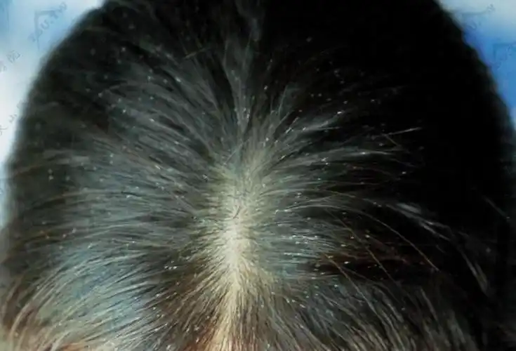 毛发管型毛周角质管型