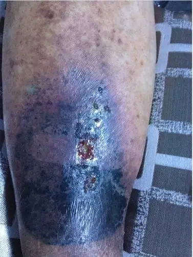 我爷爷小腿溃烂,以前有肝病史…溃烂处发黑,谁知道是什么原因