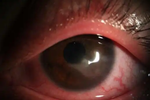 bkc——睑缘炎相关角结膜炎_结膜炎_症状表现_治疗方式 - 好大夫在线