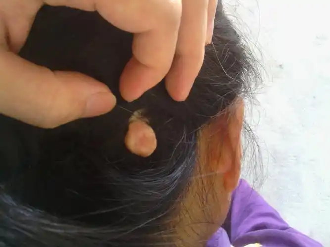 问:头上长了一个肉疙瘩,十五六年了,很大(如下图)