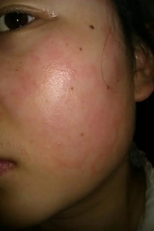 脸被爆晒过一次后出现大片红疙瘩,有点痒怎么办?