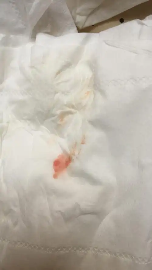 问:怀孕51天,刚才小便擦拭有点血,咋回是,40天的时候做比超有宫腔积血