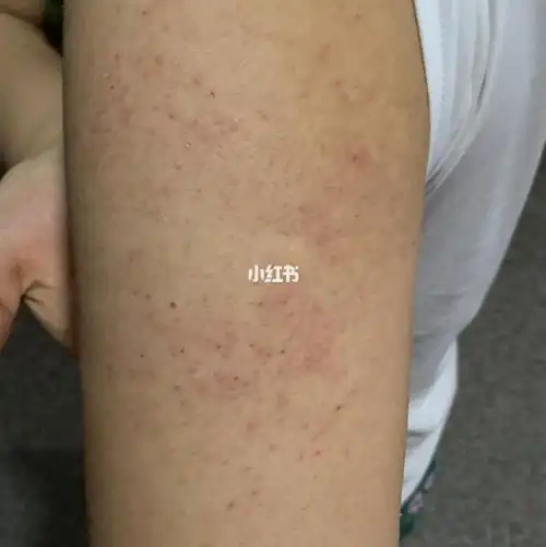 有和我一样手臂毛囊炎吗?有没治好?求治疗方法