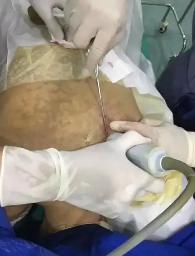 我们在b超引导下取拨针依次刺入左侧胸2-胸6节段椎旁处,术中穿刺到位