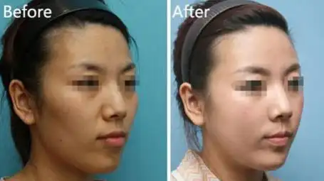 皮肤暗黄打美白针能全身变白吗