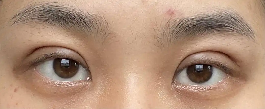 提问眼皮颜色这么深正常吗