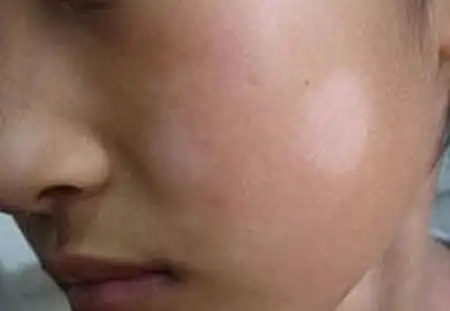 沈阳中亚研究所介绍晕痣又称离心性后天性白斑,也是指围绕色素痣的