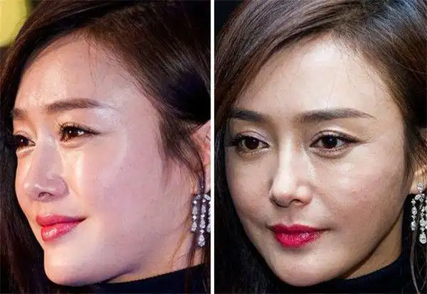 秦岚自曝脸上曾长200个痘痘网友看得出她多爱陆川